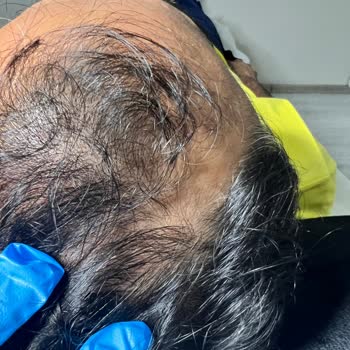 Saç Çoğaltma İşleminde Vaad Edilen Sonuçlar Gerçekleşmedi, Ücret İadesi Ve Açıklama Talebi