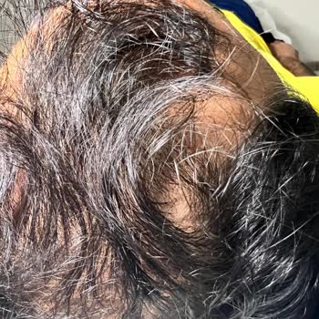 Saç Çoğaltma İşleminde Vaad Edilen Sonuçlar Gerçekleşmedi, Ücret İadesi Ve Açıklama Talebi