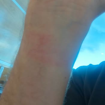 Huawei Watch D2 Causes Allergic Reaction and Return Dispute