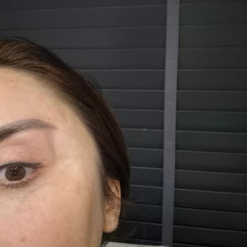 Şakak Ve Boyun Germe Sonrası Çökme Ve Asimetri İçin Revizyon Ve Telafi Talebi