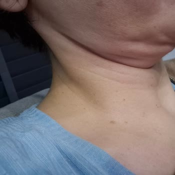Şakak Ve Boyun Germe Sonrası Çökme Ve Asimetri İçin Revizyon Ve Telafi Talebi