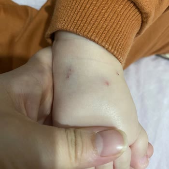 6 Aylık Bebeğimde Aşırı İğne Girişimleri Ve Anestezi Sorunları