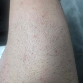 Hijyen Eksikliği, Ağrılı Lazer Epilasyon Ve Cilt Hasarı Nedeniyle Ücret İadesi Talebi