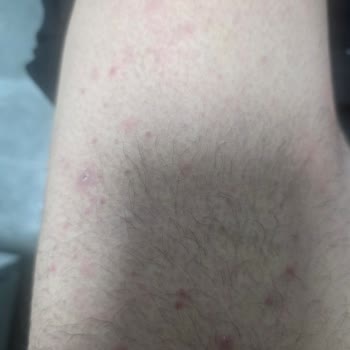 Hijyen Eksikliği, Ağrılı Lazer Epilasyon Ve Cilt Hasarı Nedeniyle Ücret İadesi Talebi