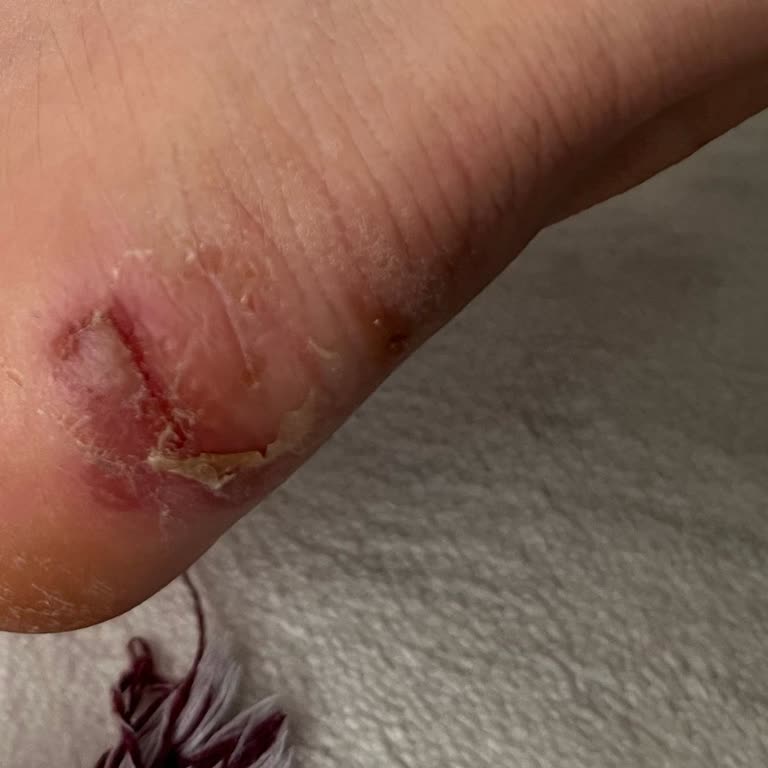 Ayakkabıda Yara Açması Ve İade Talebimin Reddedilmesi