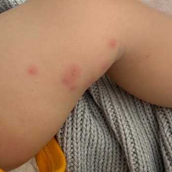 Bebek Beşiğinde Saç Ve Kıl Bulunması Nedeniyle Alerjik Reaksiyon Ve Mağazadan Cevap Beklenmesi