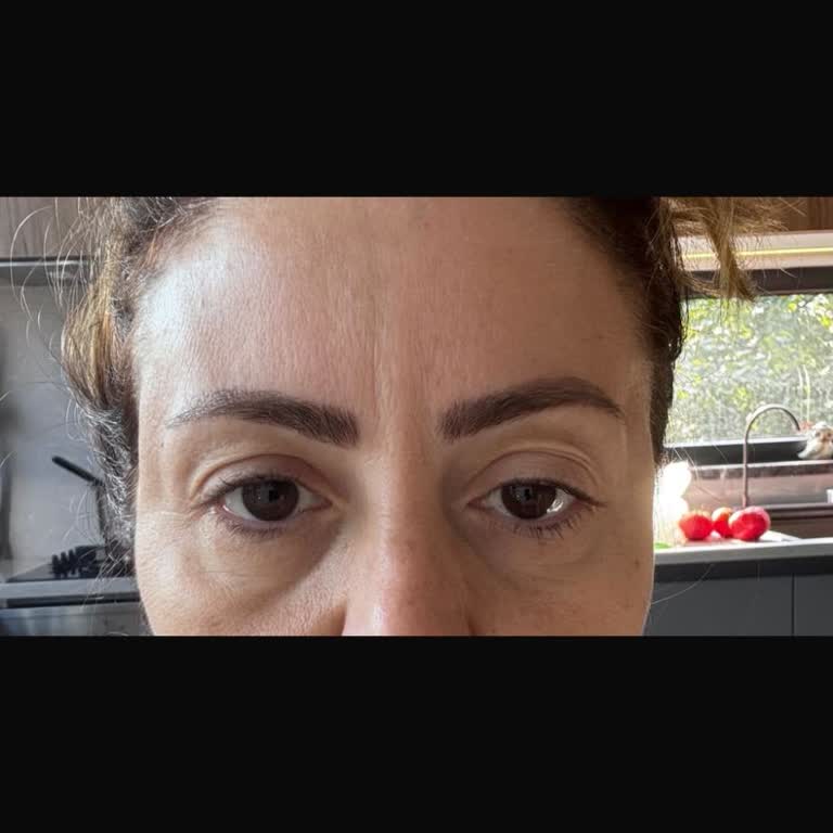Estetik Klinik Botoks Ve Dolgu Sonrası Şiddetli Sağlık Sorunları Ve İade Talebi