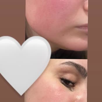Dermatoloji Bölümünde Uzun Süreli Kortizon Kullanımıyla Artan Cilt Hasarı Ve 10.000 TL İade Talebi