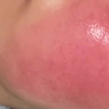 Dermatoloji Bölümünde Uzun Süreli Kortizon Kullanımıyla Artan Cilt Hasarı Ve 10.000 TL İade Talebi