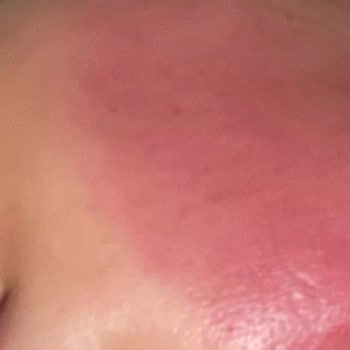 Dermatoloji Bölümünde Uzun Süreli Kortizon Kullanımıyla Artan Cilt Hasarı Ve 10.000 TL İade Talebi