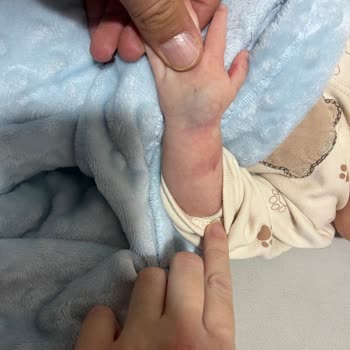 Ümraniye Devlet Hastanesi Pediatrik Hemşire Bebeğin Parmağını Aşırı Sıkması