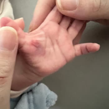 Ümraniye Devlet Hastanesi Pediatrik Hemşire Bebeğin Parmağını Aşırı Sıkması