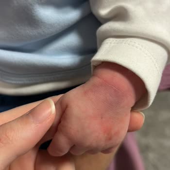 Ümraniye Devlet Hastanesi Pediatrik Hemşire Bebeğin Parmağını Aşırı Sıkması