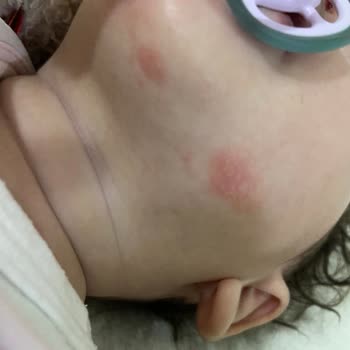 Mustela Stelatopia Kremi Çocukta Yanma Ve Kızarıklığa Neden Oldu, İade Talebi