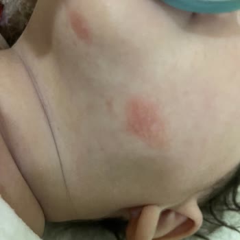 Mustela Stelatopia Kremi Çocukta Yanma Ve Kızarıklığa Neden Oldu, İade Talebi