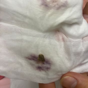 Uni Baby Islak Pamuk Mendilinde Mor Lekeler Ve Yabancı Madde: Bebek Güvenliği Endişesi