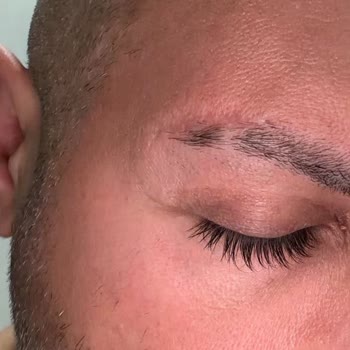 Ota Jinemed Hastanesi Kaş Ameliyatı Sonrası Belirgin Dikiş İzleri Ve Takip Eksikliği