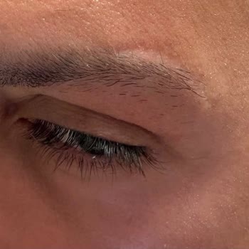 Ota Jinemed Hastanesi Kaş Ameliyatı Sonrası Belirgin Dikiş İzleri Ve Takip Eksikliği
