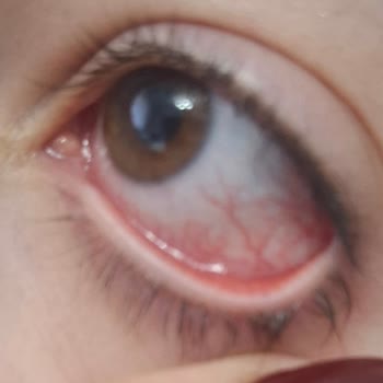Sahte L’Loreal Telescopic Maskara Göz Enfeksiyonu Ve Eksik İade