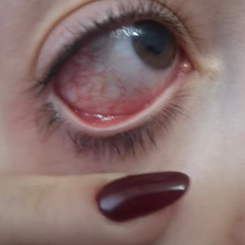 Sahte L’Loreal Telescopic Maskara Göz Enfeksiyonu Ve Eksik İade