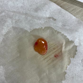 Medical Park Ankara Batıkent Hastanesi'nde Burun Ameliyatı Sonrası Nefes Darlığı, Polip Oluşumu Ve Yetersiz İletişim