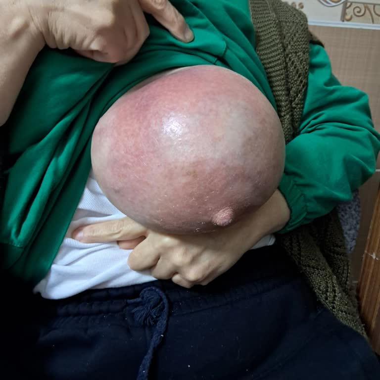 Kayseri Acıbadem Hastanesinde Enfeksiyonlu Kanser Hastasına Kemoterapi Devam Ettirildiği Tıbbi İhmal
