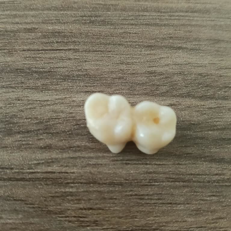 İmplant Üzerindeki Zirkonyum Kaplamaların Sürekli Düşmesi Ve Garanti İhlali