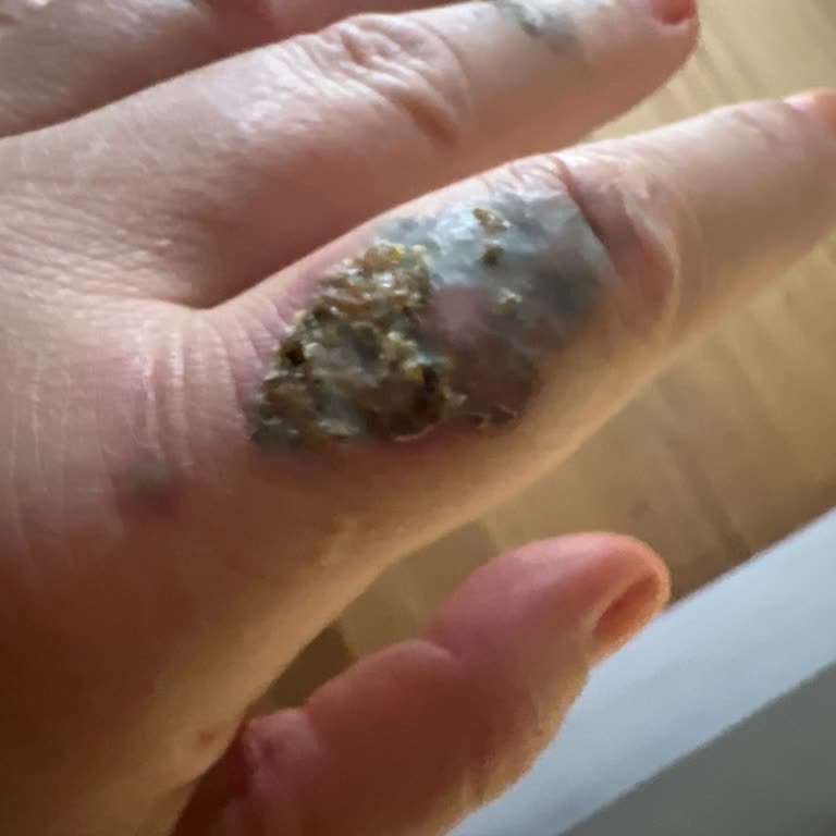 Pamela Güzellik Şubesinde İğneli Epilasyon Söz Verilen Sonuç Vermedi Ve Dövme Silme Sonrası Ciddi Tahriş