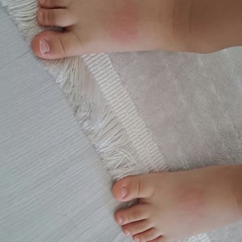 Vicco Ayakkabısının Sert Kalıbı Ve Hatalı Dikişi Çocuğunun Ayağını Yaraladı