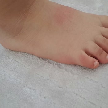 Vicco Ayakkabısının Sert Kalıbı Ve Hatalı Dikişi Çocuğunun Ayağını Yaraladı