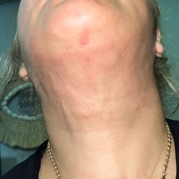 Klinikte Lipoliz İşlemi Sonrası Kalıcı Yanık İzleri Ve İade Talebi