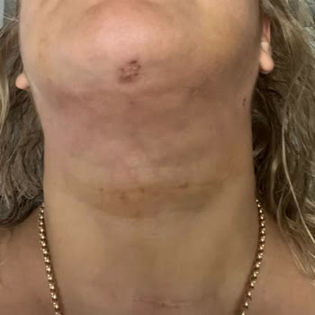 Klinikte Lipoliz İşlemi Sonrası Kalıcı Yanık İzleri Ve İade Talebi
