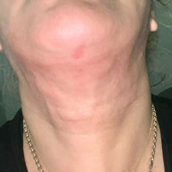 Klinikte Lipoliz İşlemi Sonrası Kalıcı Yanık İzleri Ve İade Talebi