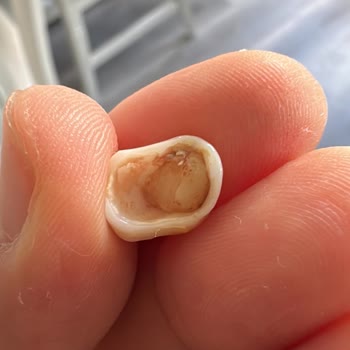 Lema Dental'de Uzun Süreli Gecikme Ve Kırılan Zirkonyum Kaplama Sonrası Çözüm Bulamama