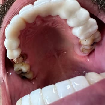 Lema Dental'de Uzun Süreli Gecikme Ve Kırılan Zirkonyum Kaplama Sonrası Çözüm Bulamama