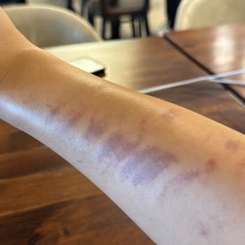 Rosso Şubesinde Lazer Epilasyon Yanığı Ve Cevapsız Tutum