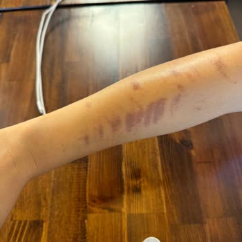 Rosso Şubesinde Lazer Epilasyon Yanığı Ve Cevapsız Tutum