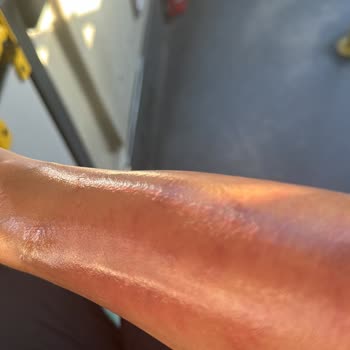Rosso Şubesinde Lazer Epilasyon Yanığı Ve Cevapsız Tutum