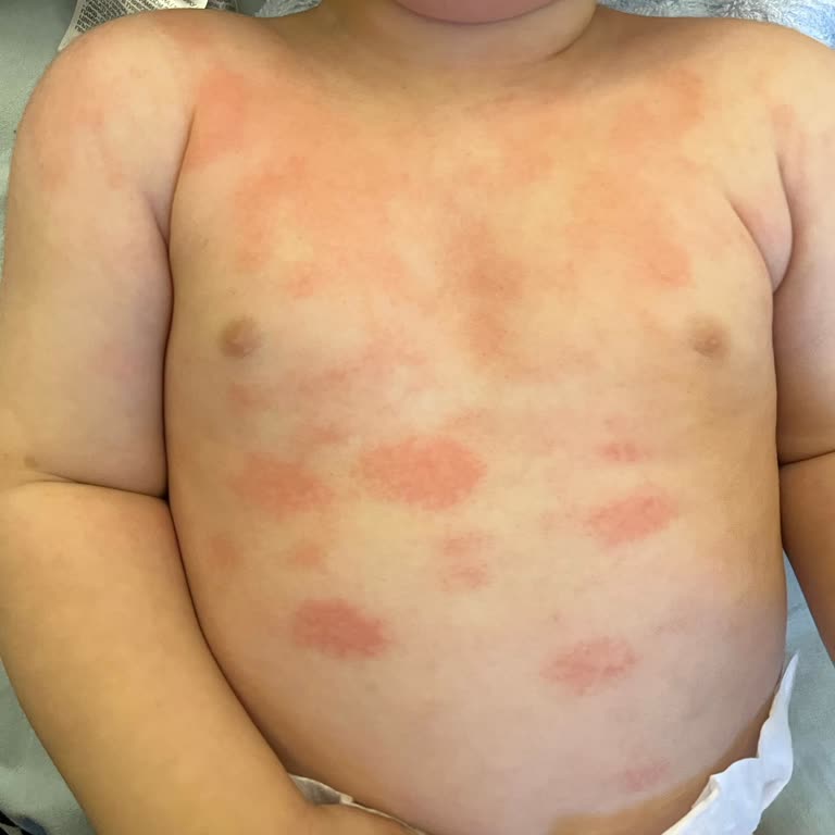 Mustela Yenidoğan Şampuanı İkinci Kutuda Bebekte Atopik Dermatit Ve Şiddetli Kızarıklık