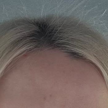 Akın Akça Hair Atelier Yaşadığım Saç Kopması Ve Sonrasındaki Süreç