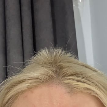 Akın Akça Hair Atelier Yaşadığım Saç Kopması Ve Sonrasındaki Süreç