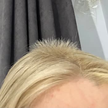 Akın Akça Hair Atelier Yaşadığım Saç Kopması Ve Sonrasındaki Süreç