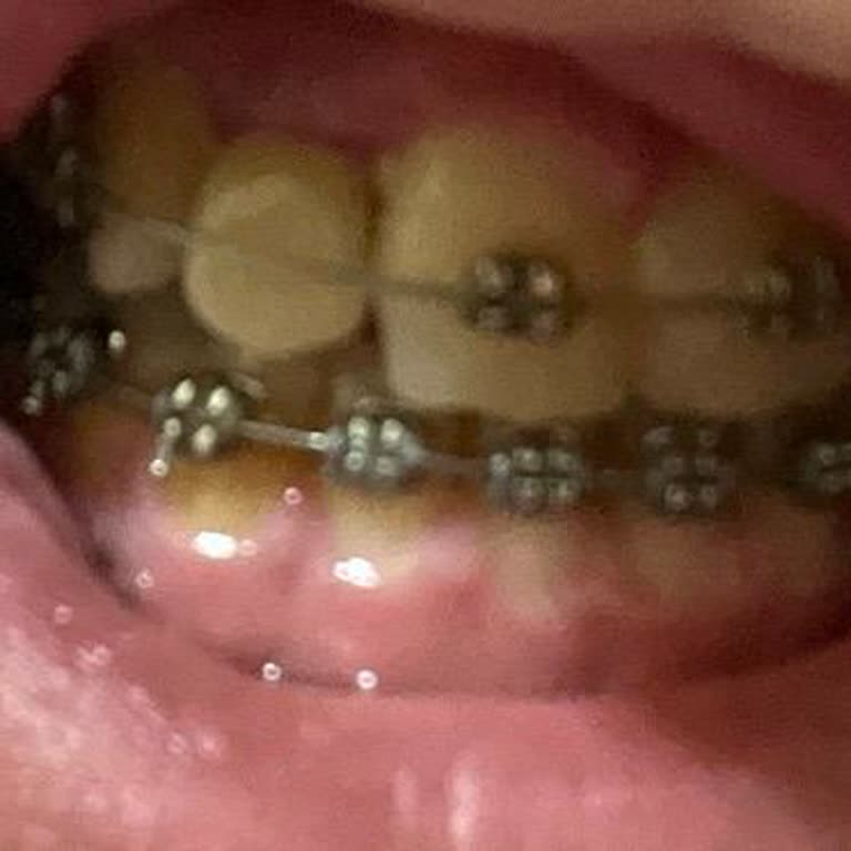 İmplant Tedavisinde Sürekli Hata Ve Estetik Sorunları Denta Center Keçiören Şikayetim
