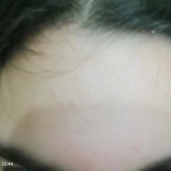 Gratis Mağazasında Yanlış Ürün Önerisi Nedeniyle Cilt Hasarı Ve İade Talebi