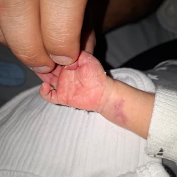 Devlet Hastanesinde Bebek Kan Alımında Aşırı Sıkma Ve Tekrarlanan İğne Denemeleriyle Oluşan Morluk