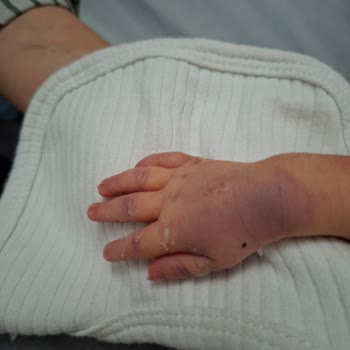Devlet Hastanesinde Bebek Kan Alımında Aşırı Sıkma Ve Tekrarlanan İğne Denemeleriyle Oluşan Morluk