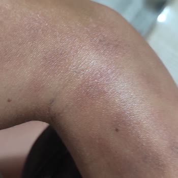 Antalya Lavinya Güzellik Merkezi'nde Lazer Epilasyon Sonrası Yanık Ve İlgisizlik