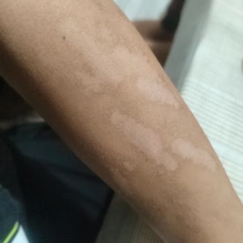 Antalya Lavinya Güzellik Merkezi'nde Lazer Epilasyon Sonrası Yanık Ve İlgisizlik