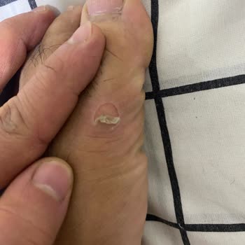 Lorvenzo Deri Sneaker'da Ayak Yarası Ve Şiddetli Ağrı, İade Talebi Cevapsız
