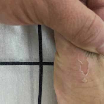 Lorvenzo Deri Sneaker'da Ayak Yarası Ve Şiddetli Ağrı, İade Talebi Cevapsız